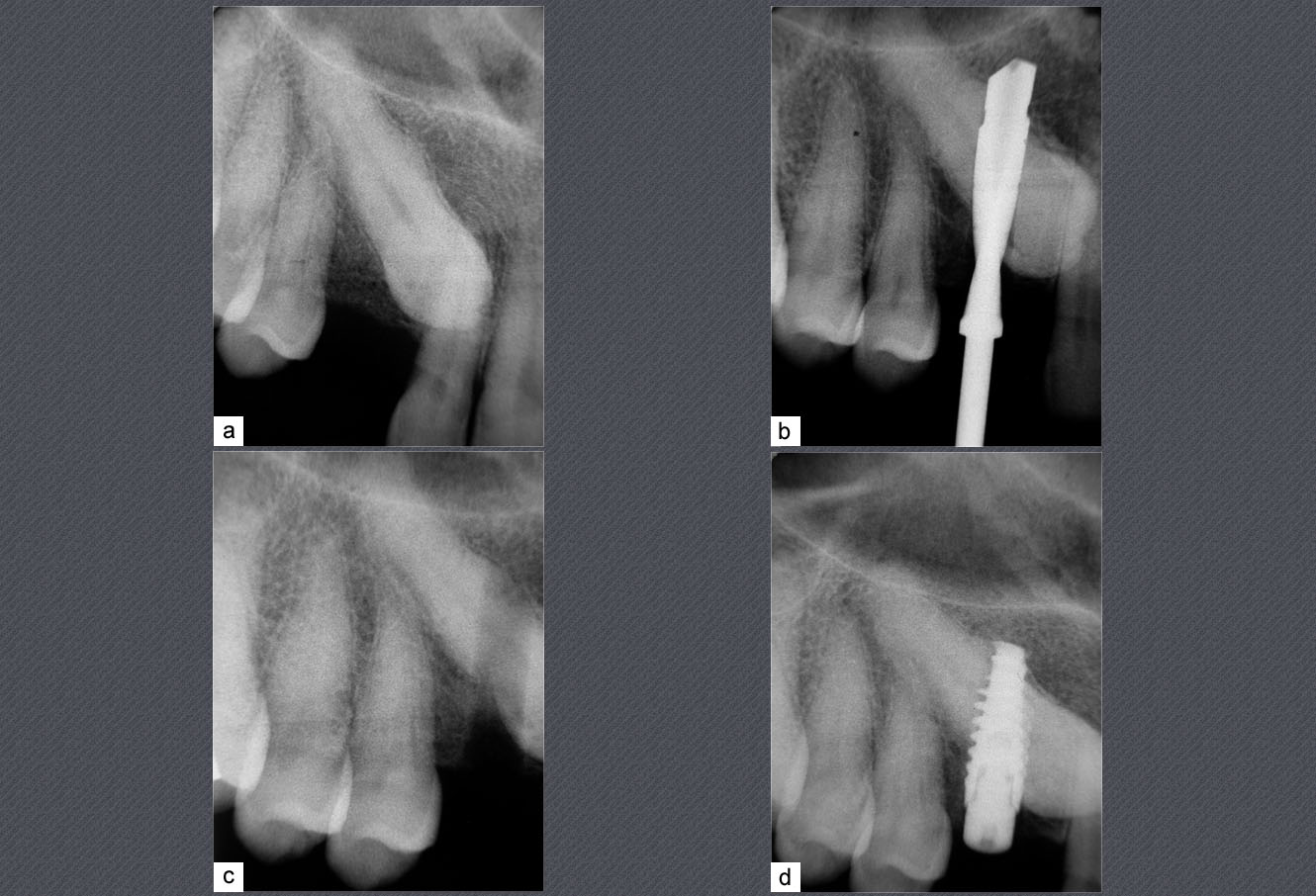 canine incluse, implant dentaire