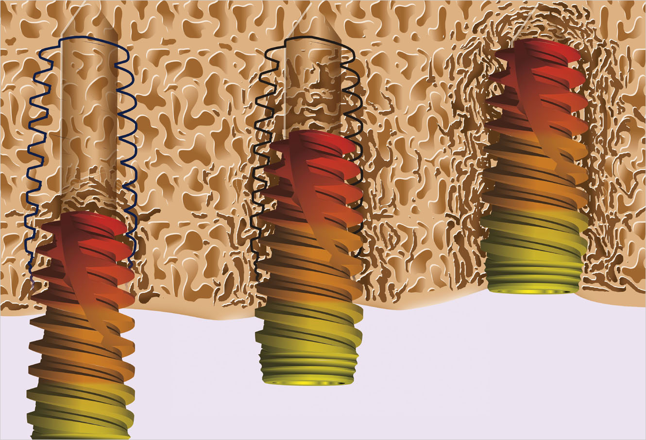 canine incluse, implant dentaire