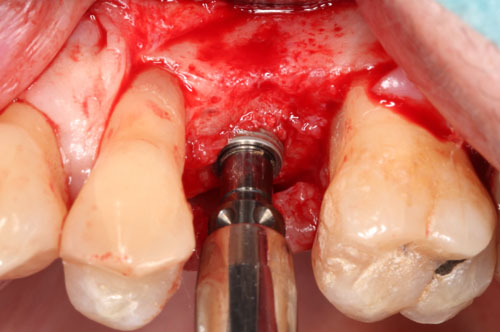 dévissage de l'implant