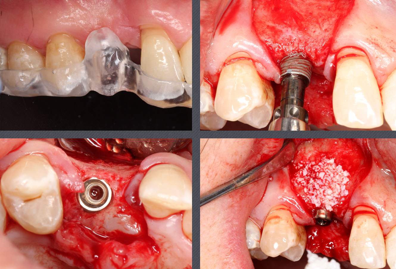 canine incluse, implant dentaire