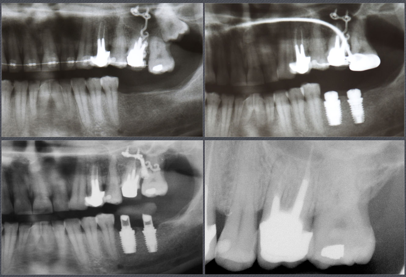 canine incluse, implant dentaire