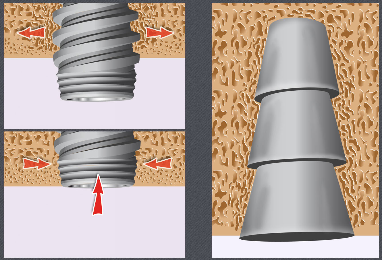 canine incluse, implant dentaire