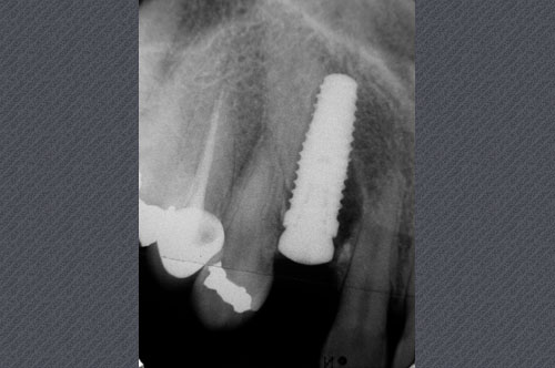 implant en place
