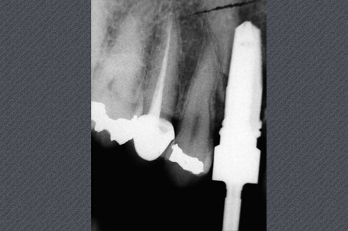 radiographie rétroalvéolaire