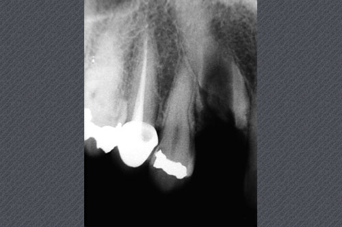 radiographie rétroalvéolaire après passage du foret