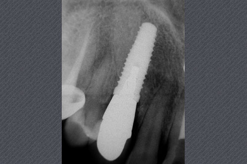 radiographie rétroalvéolaire