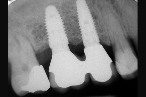 radiographie de contrôle