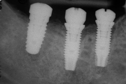 radiographie postoperatoire