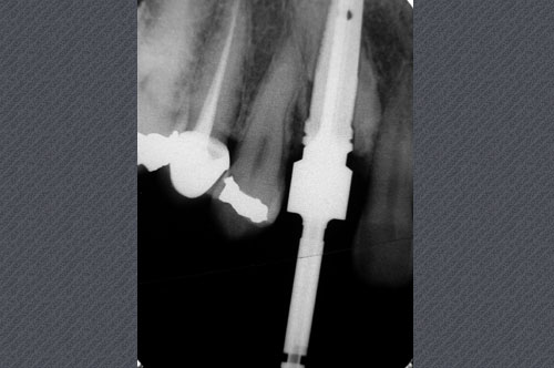 radiographie rétroalvéolaire canine incluse