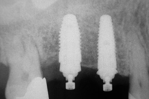 radiographie rétroalvéolaire postopératoire