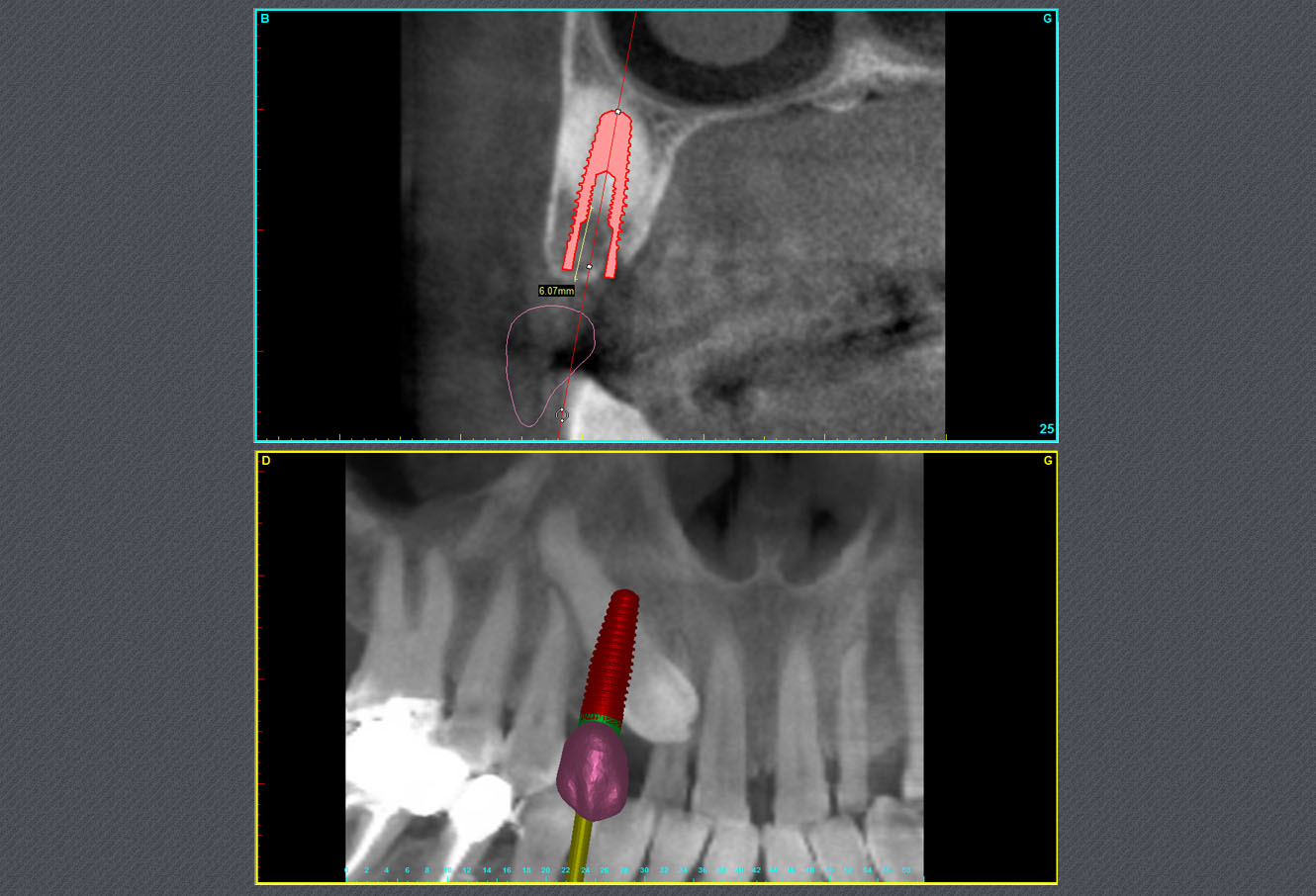 canine incluse, implant dentaire