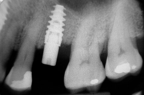 radiographie des piliers et du bridge