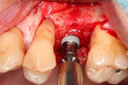 vissage et dévissage de l'implant