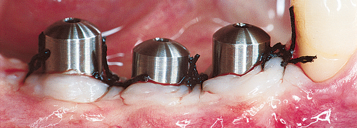implant dentaire titane