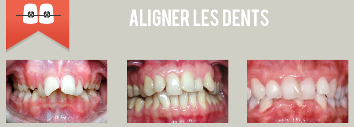 aligner les dents en orthodontie