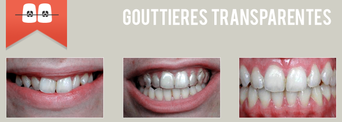 gouttières transparentes