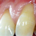récession gingivale