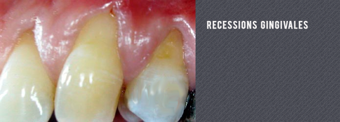 récession gingivale