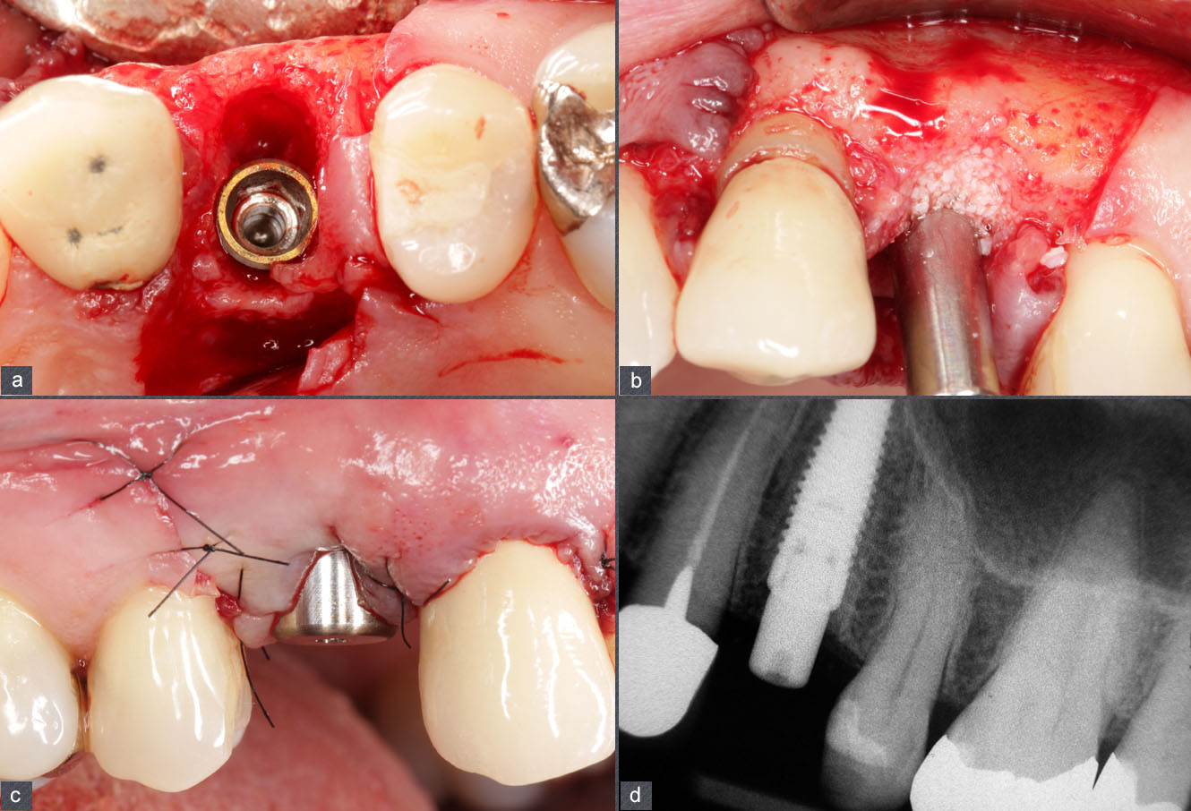 platform switching, Protocole d'extraction-implantation-temporisation immédiate à l'aide d'un bridge collé