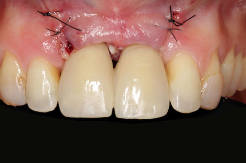 prothèse provisoire transvissée