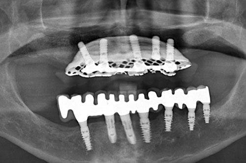 radiographie de contrôle