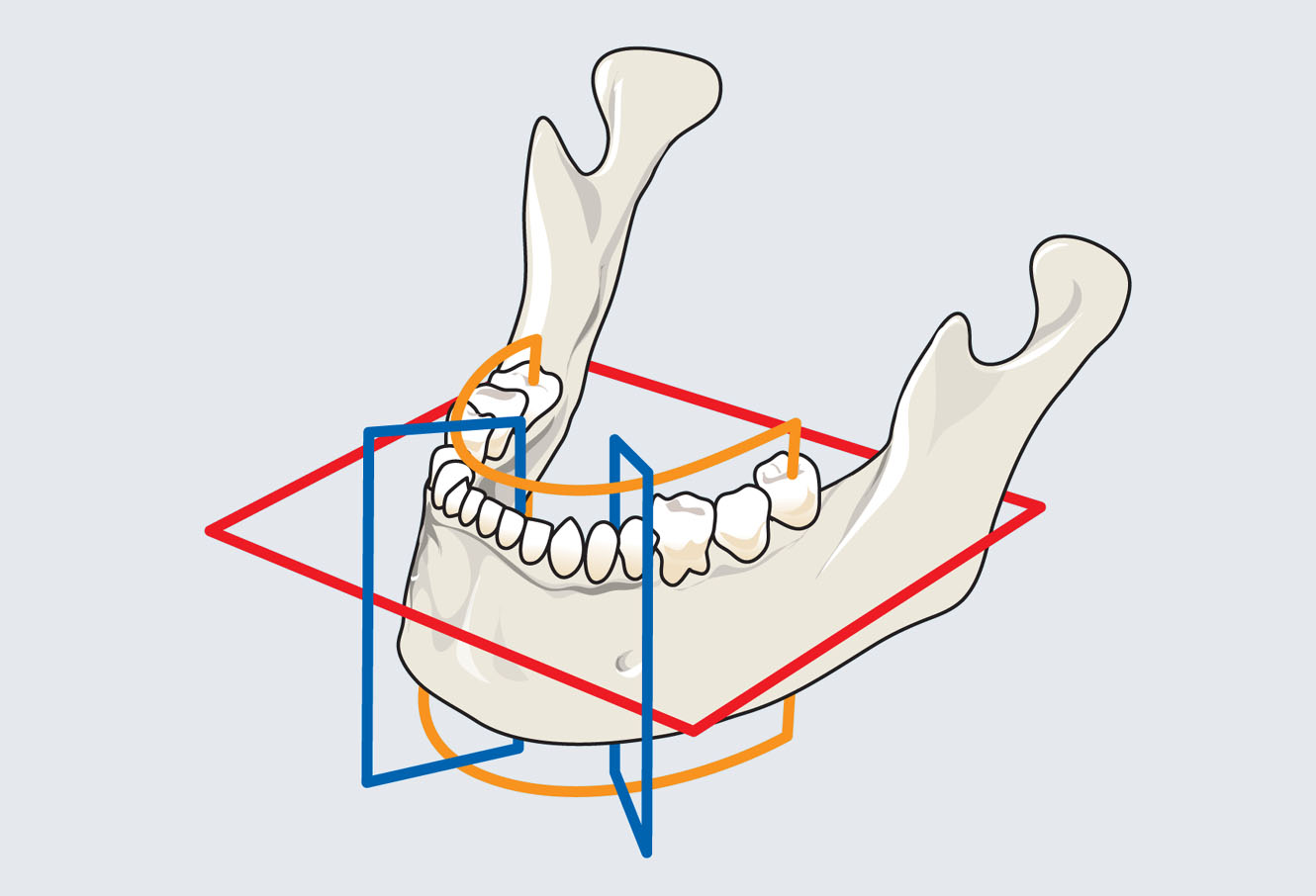 examen tomodensitométrique scanner ou CBCT, cone beam computerized tomography