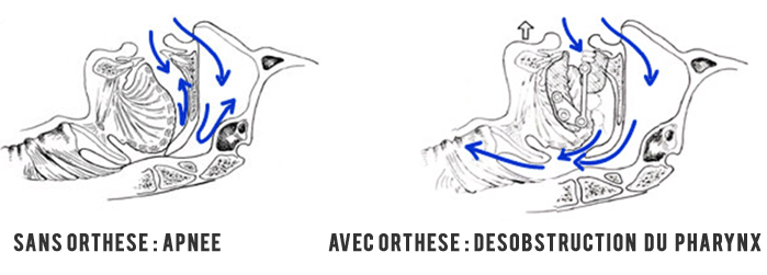 orthèse d'avancée mandibulaire