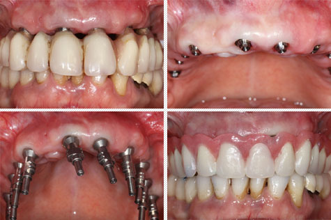 Charge immédiate sur implant dentaire - Des dents provisoires directement