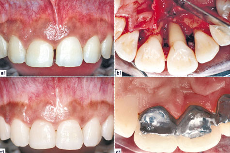 diagnostic pre-implantaire