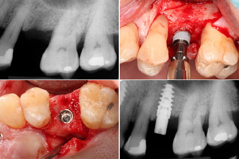 implant ostotome