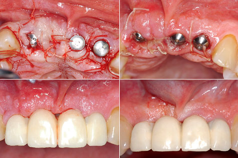 osteointégration des implants dentaires