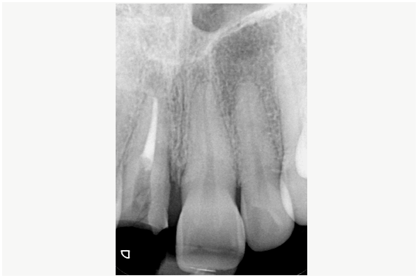 Radio fracture radiculaire