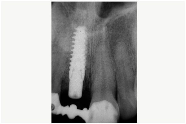 fracture radiculaire, bridge coll