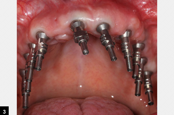 empreinte en pltre, 8 implants dentaires