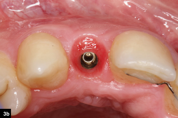 augmentation latrale implant dentaire