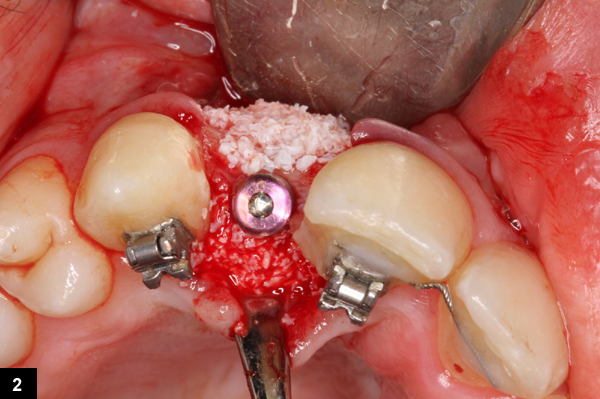 augmentation osseuse latrale