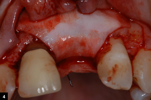 deuxime membrane rsorbable Bio-Gide