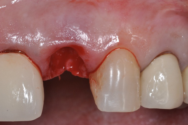 Extraction de la racine avec son tissu de granulation