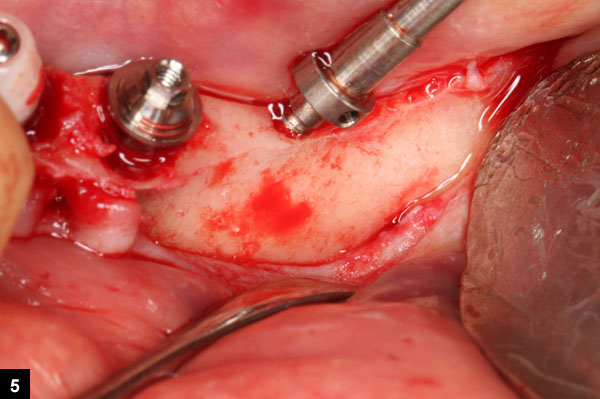implant angul