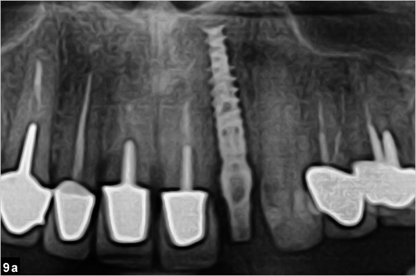 implant dentaire en place, vue agrandie