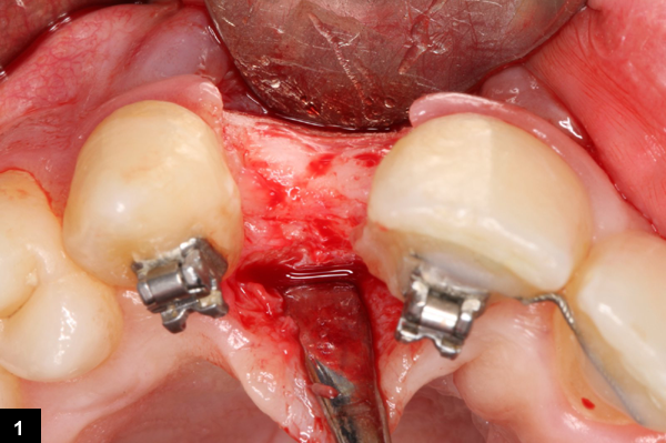 mise en place de l'implant dentaire