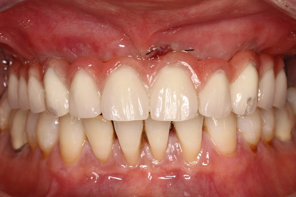 prothse dentaire provisoire
