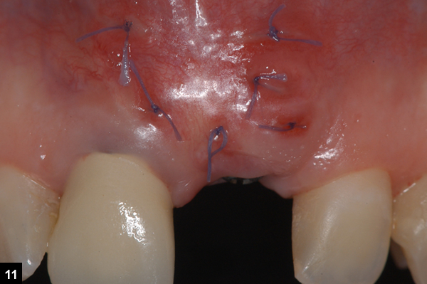 retraits fils de suture