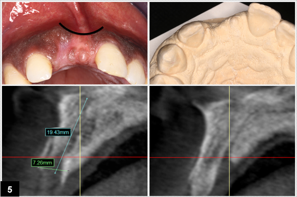 Split crest, Augmentation  du  volume  vestibulaire, Conservation  du  diastme  inter-incisif