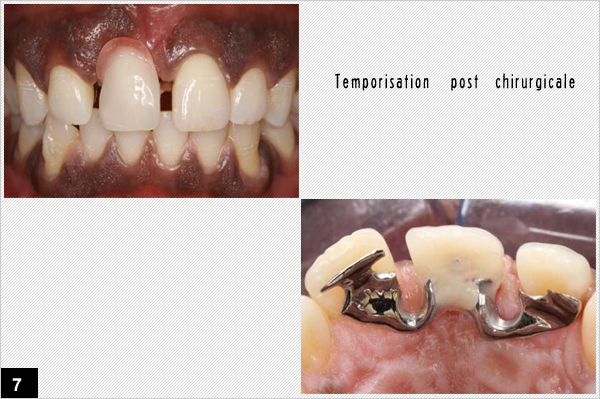 temporisation post chirurgicale