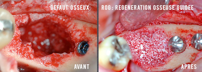 régénération osseuse guidée