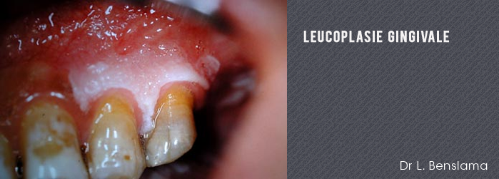 leucoplasie gingivale