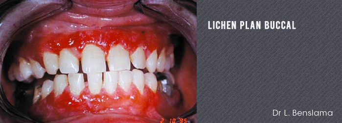 lichen plan buccal