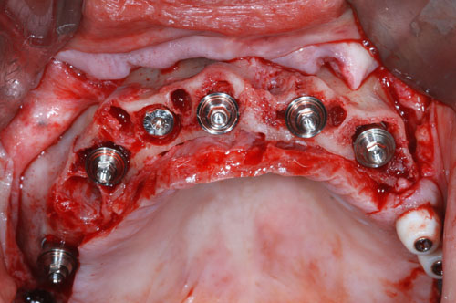 piliers MUA sur les implants