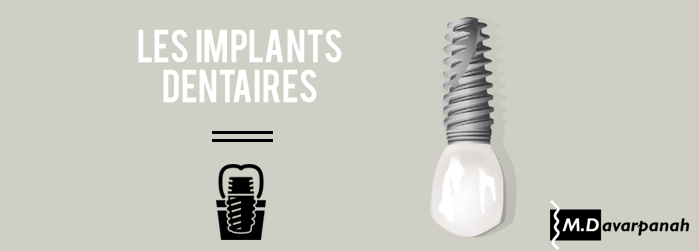 implants dentaires